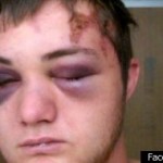 black eyes Black Eye